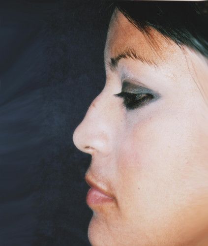 Rhinoplasty Before & After