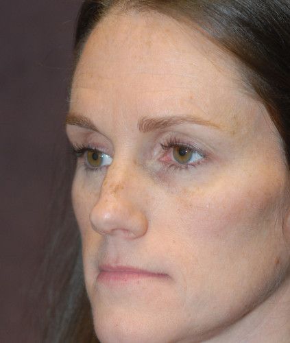 Rhinoplasty Before & After