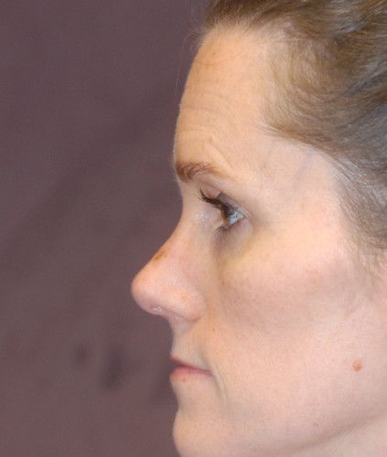 Rhinoplasty Before & After