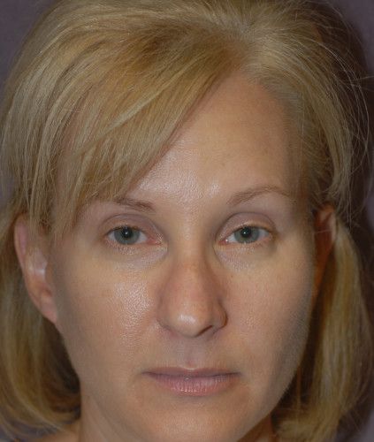 Rhinoplasty Before & After