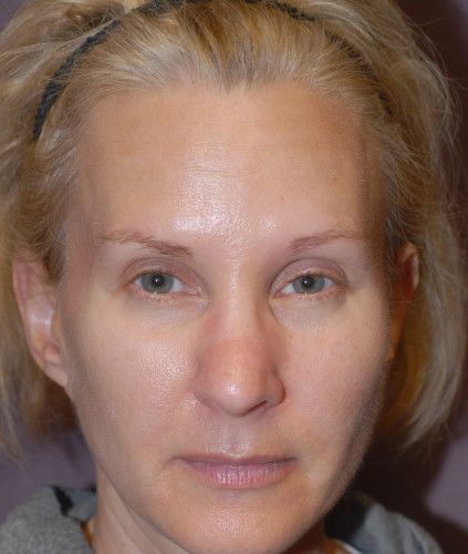 Rhinoplasty Before & After