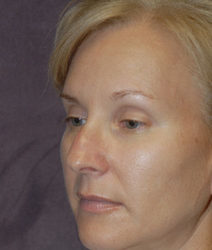 Rhinoplasty Before & After