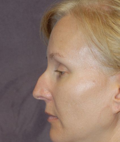 Rhinoplasty Before & After