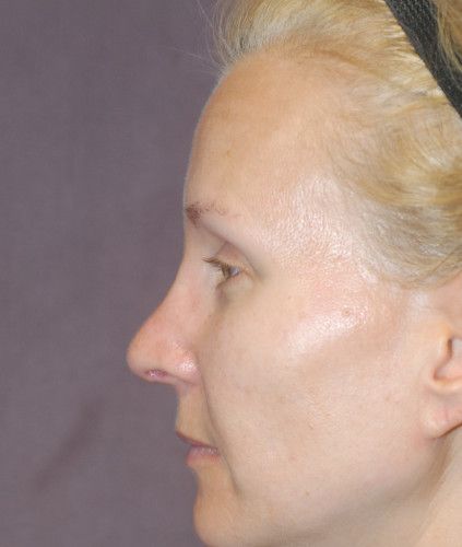 Rhinoplasty Before & After
