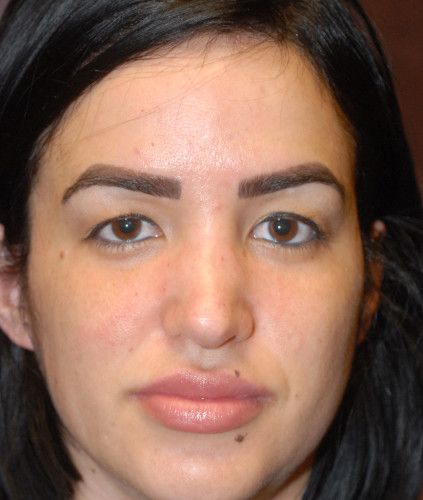 Rhinoplasty Before & After