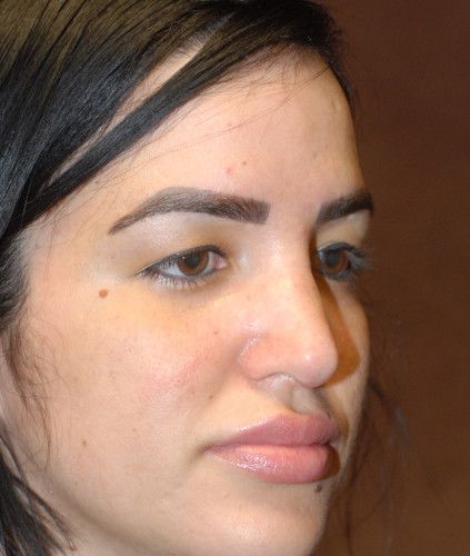 Rhinoplasty Before & After