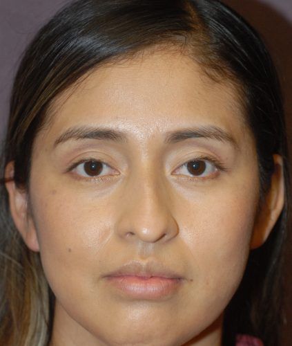 Rhinoplasty Before & After