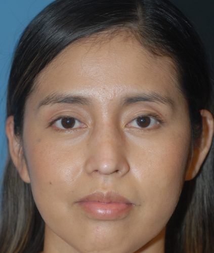 Rhinoplasty Before & After