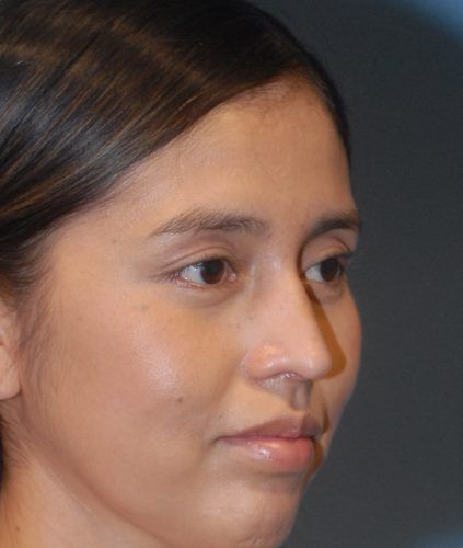 Rhinoplasty Before & After