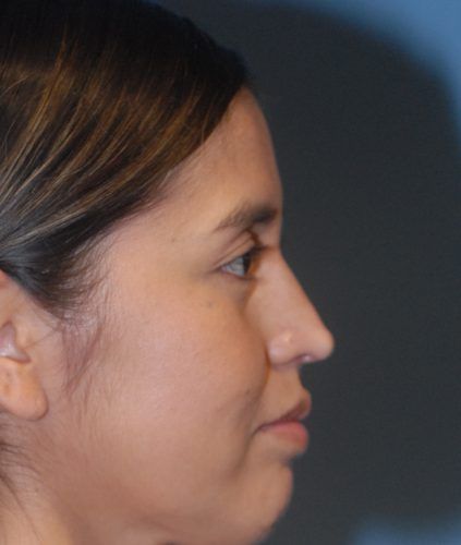 Rhinoplasty Before & After