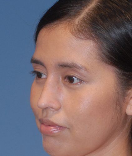 Rhinoplasty Before & After