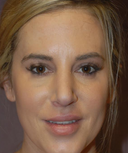 Rhinoplasty Before & After