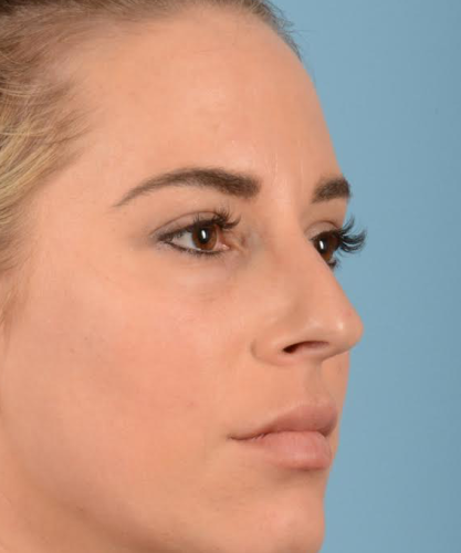 Rhinoplasty Before & After