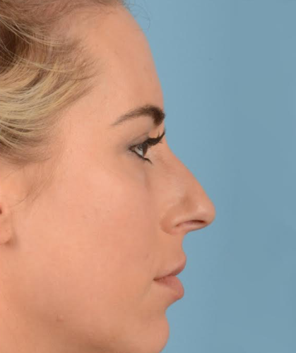 Rhinoplasty Before & After