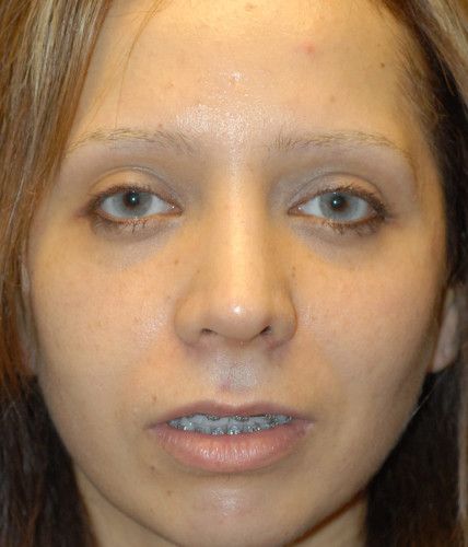 Rhinoplasty Before & After