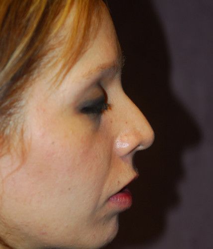 Rhinoplasty Before & After