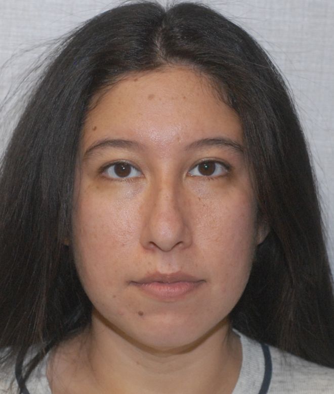 Rhinoplasty Before & After