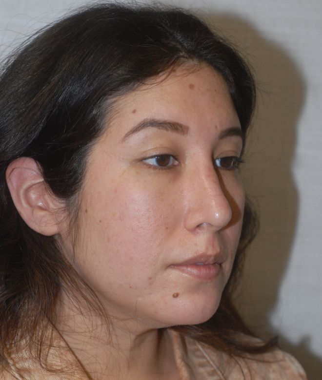 Rhinoplasty Before & After