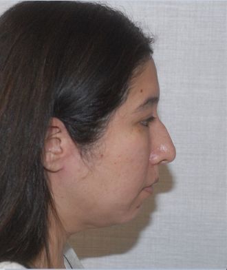 Rhinoplasty Before & After