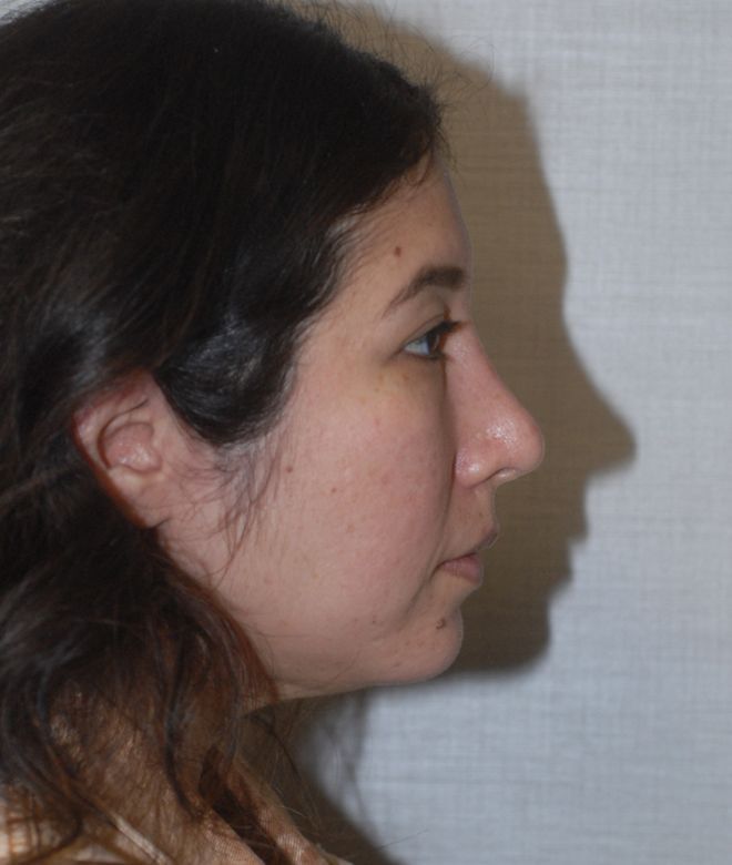 Rhinoplasty Before & After