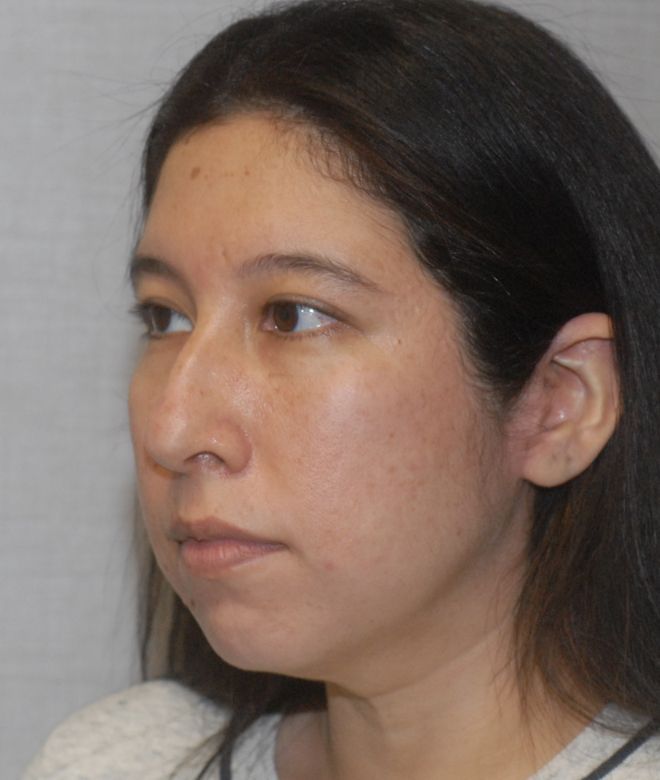 Rhinoplasty Before & After