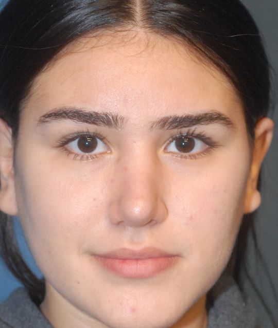 Rhinoplasty Before & After