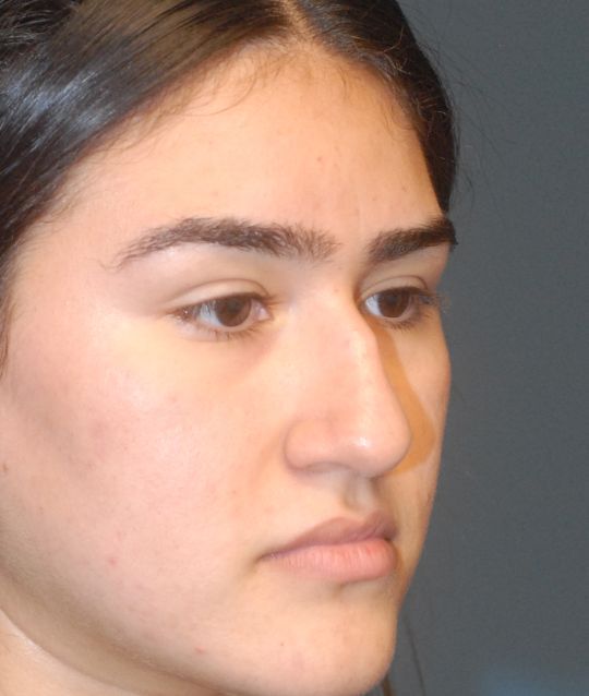 Rhinoplasty Before & After