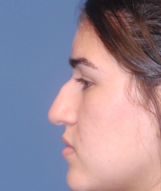 Rhinoplasty Before & After