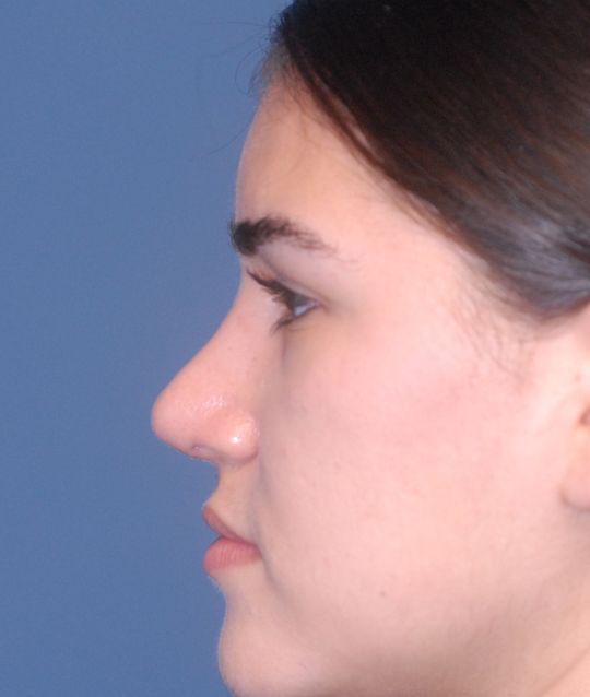 Rhinoplasty Before & After