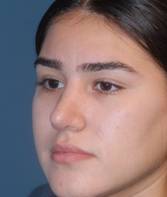 Rhinoplasty Before & After