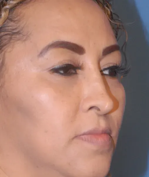 Rhinoplasty Before & After