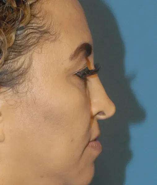 Rhinoplasty Before & After