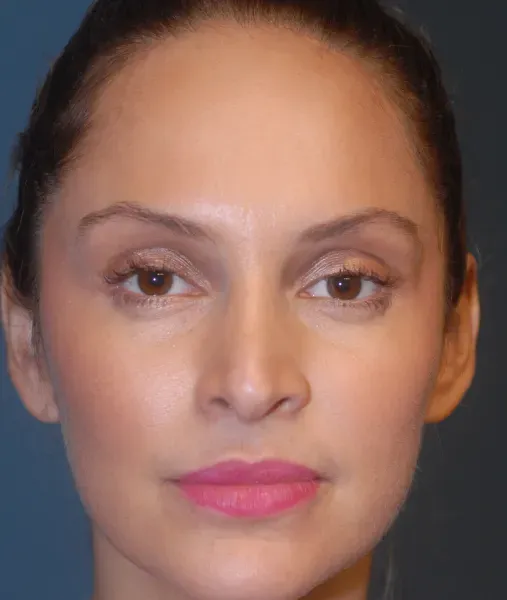 Rhinoplasty Before & After