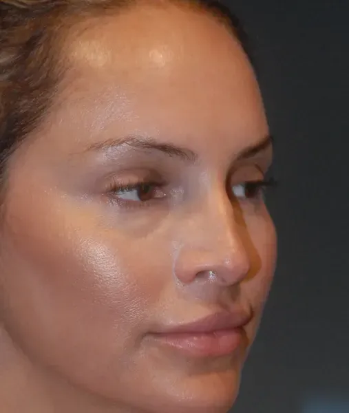 Rhinoplasty Before & After