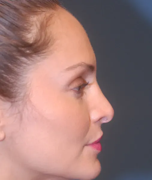 Rhinoplasty Before & After