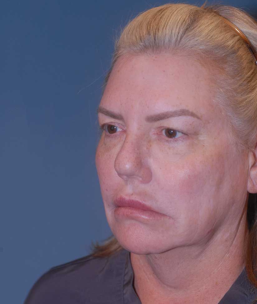 Rhinoplasty Before & After