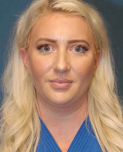 Rhinoplasty Before & After