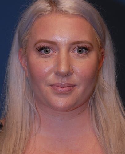 Rhinoplasty Before & After