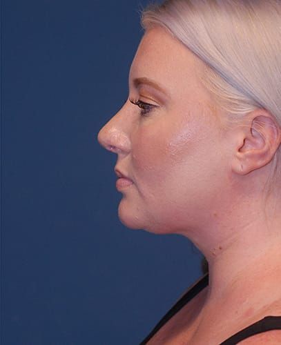 Rhinoplasty Before & After