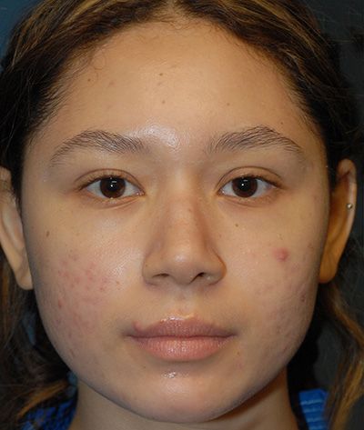 Rhinoplasty Before & After