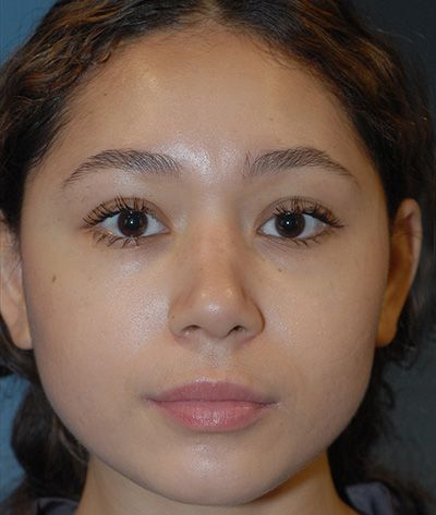 Rhinoplasty Before & After