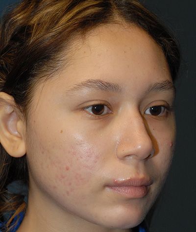 Rhinoplasty Before & After