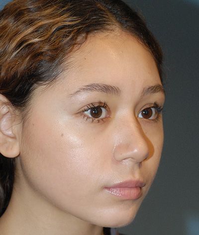 Rhinoplasty Before & After