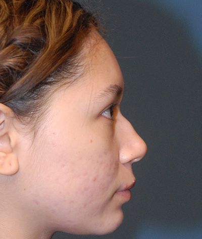 Rhinoplasty Before & After