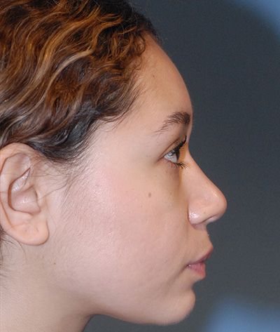 Rhinoplasty Before & After