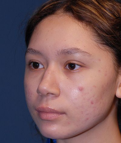 Rhinoplasty Before & After