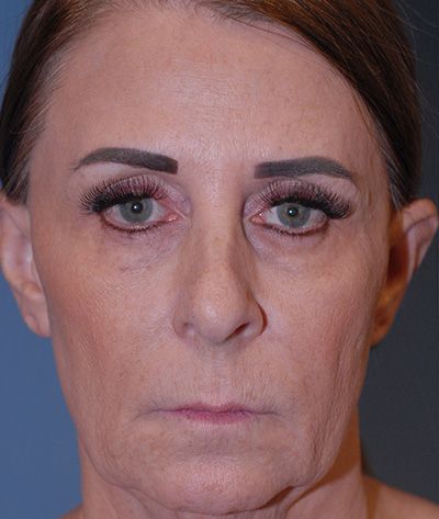 Rhinoplasty Before & After