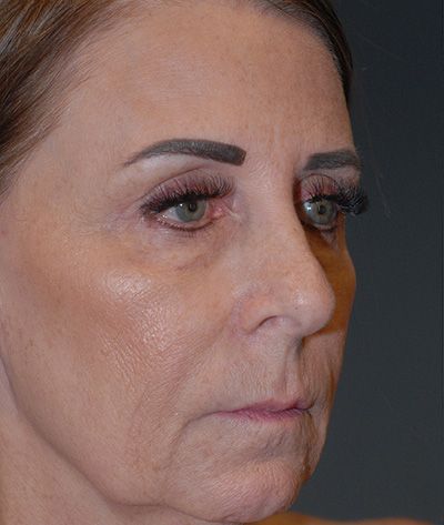 Rhinoplasty Before & After