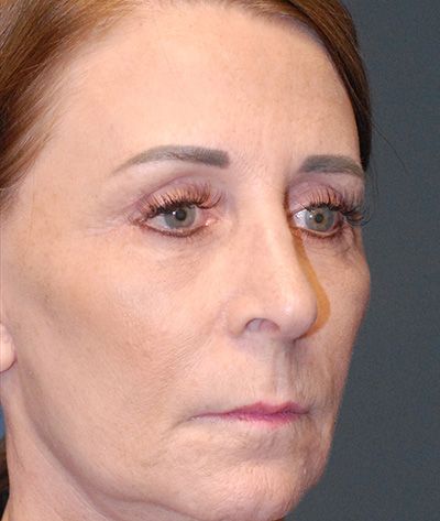 Rhinoplasty Before & After