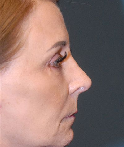 Rhinoplasty Before & After